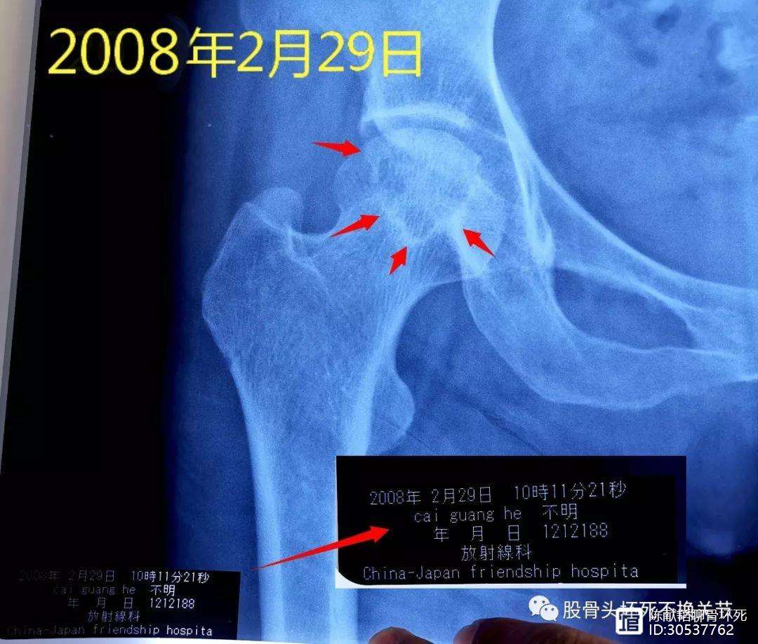 惠州人工骨头医保报销多少(人工骨头医保报销多少比例)